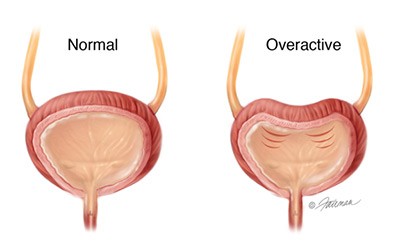 Overactive bladder without shame