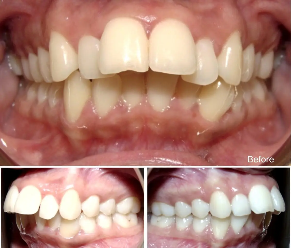 Oversized bite &#8211; types, symptoms, diagnostics. Treatment of overshot bite in children and adults