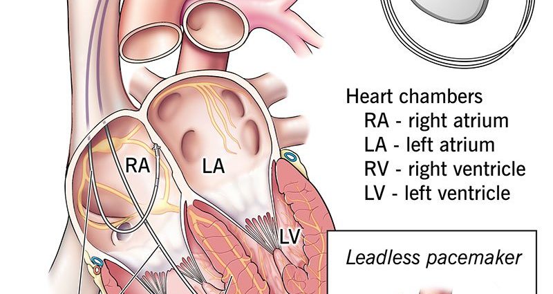 Pacemaker &#8211; indications, procedure, complications. How does a pacemaker work?