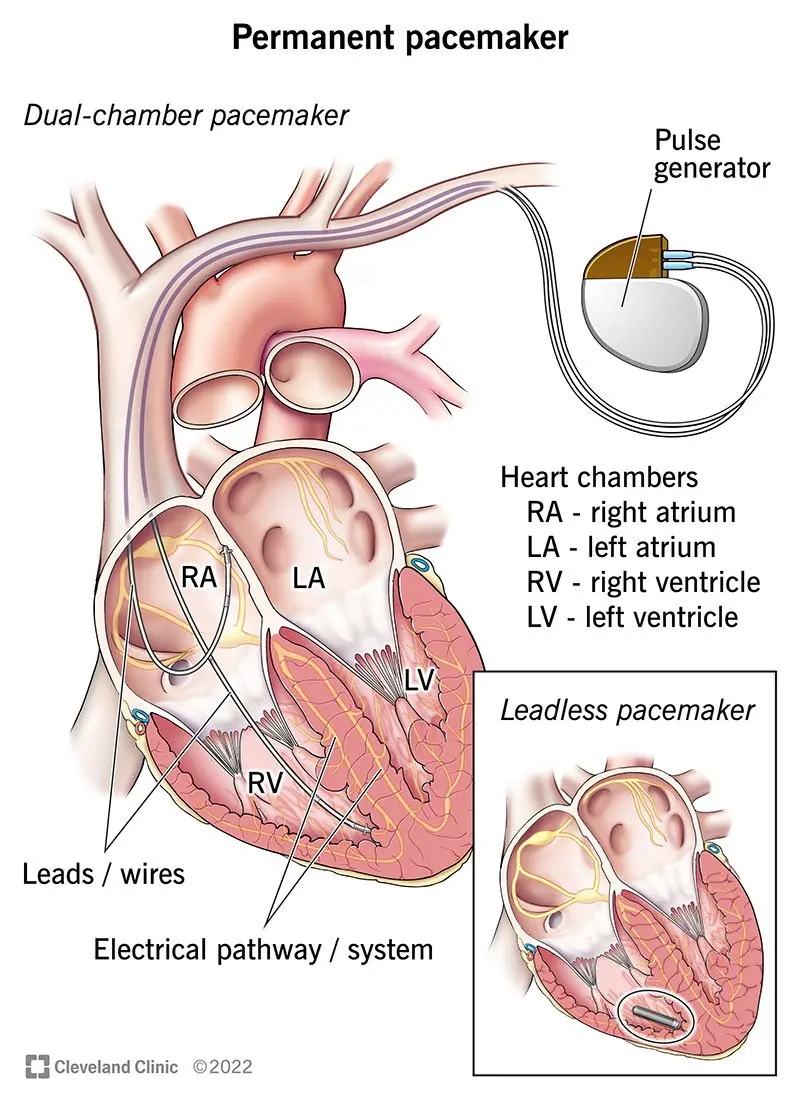 Pacemaker &#8211; indications, procedure, complications. How does a pacemaker work?