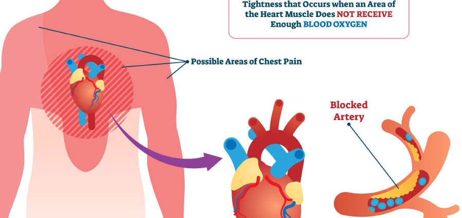 Pain in angina &#8211; causes, symptoms, treatment