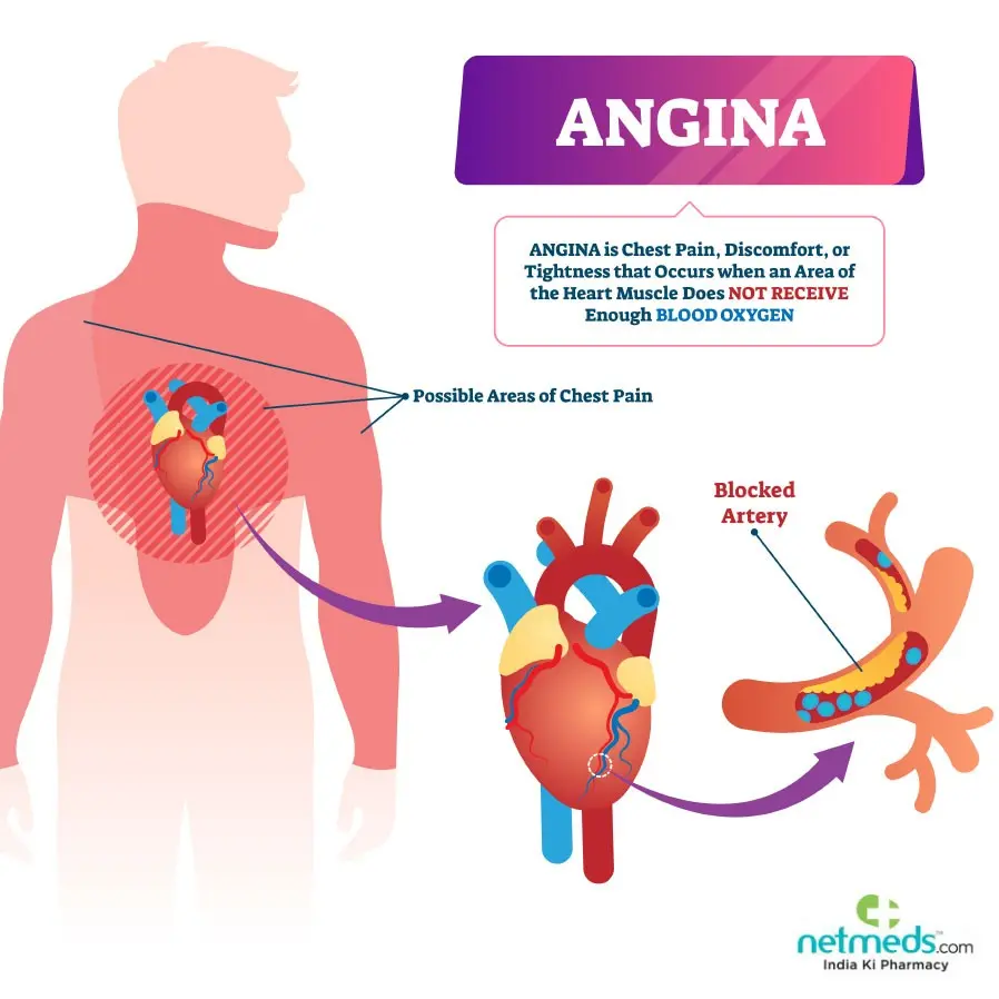 Pain in angina &#8211; causes, symptoms, treatment