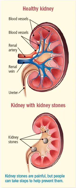 Pain in kidney stones