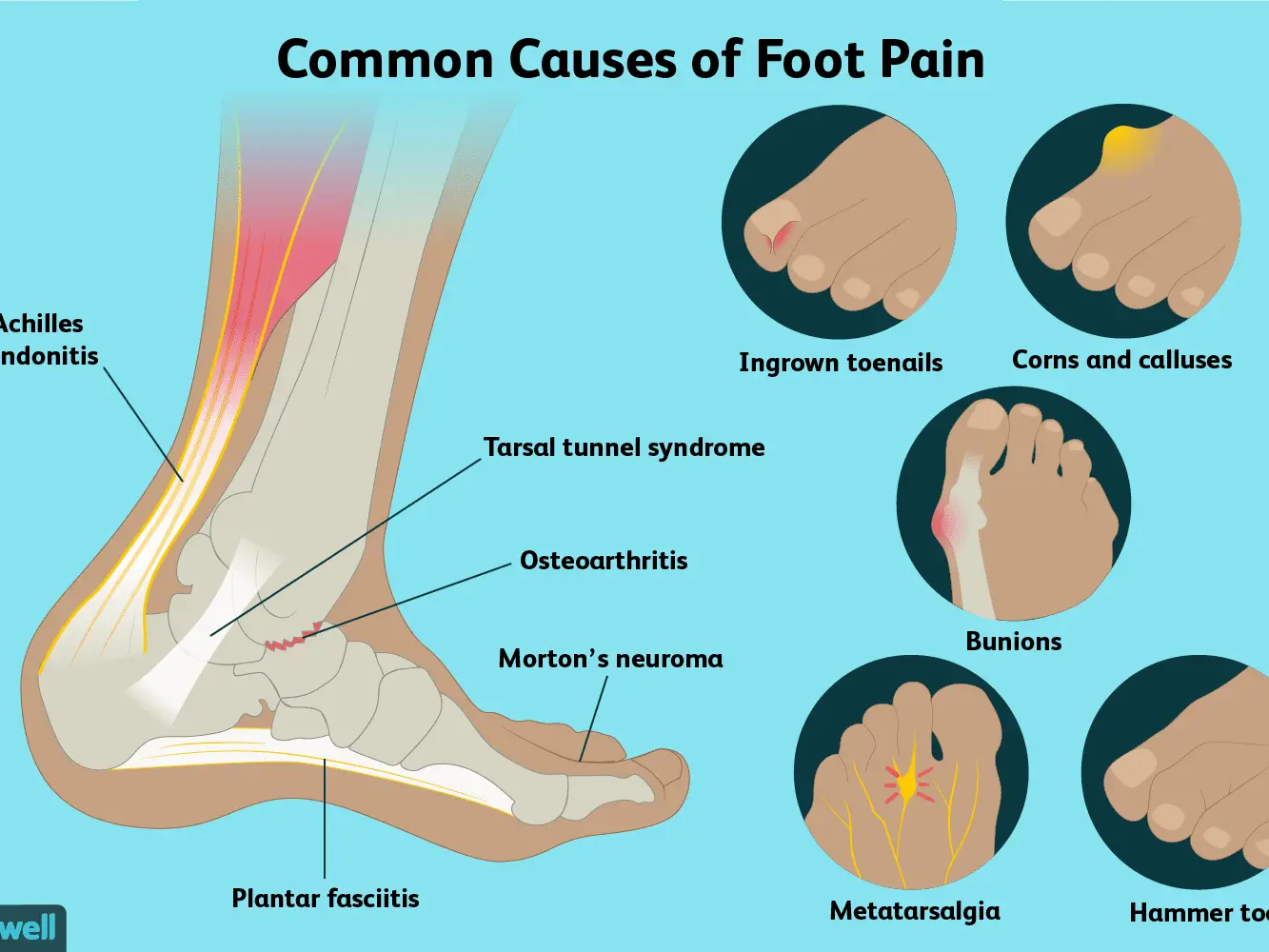 Pain in the feet (feet)