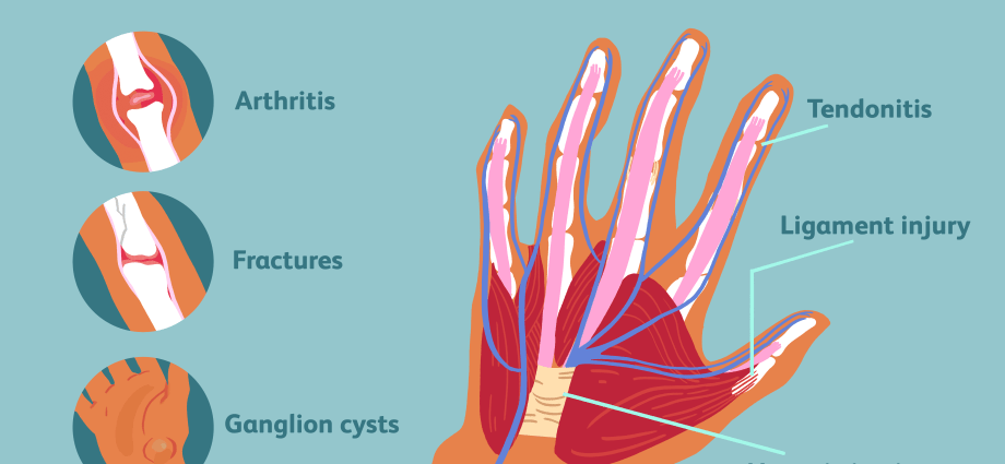 Pain in the hands and fingers &#8211; what can they be caused by? The doctor answers