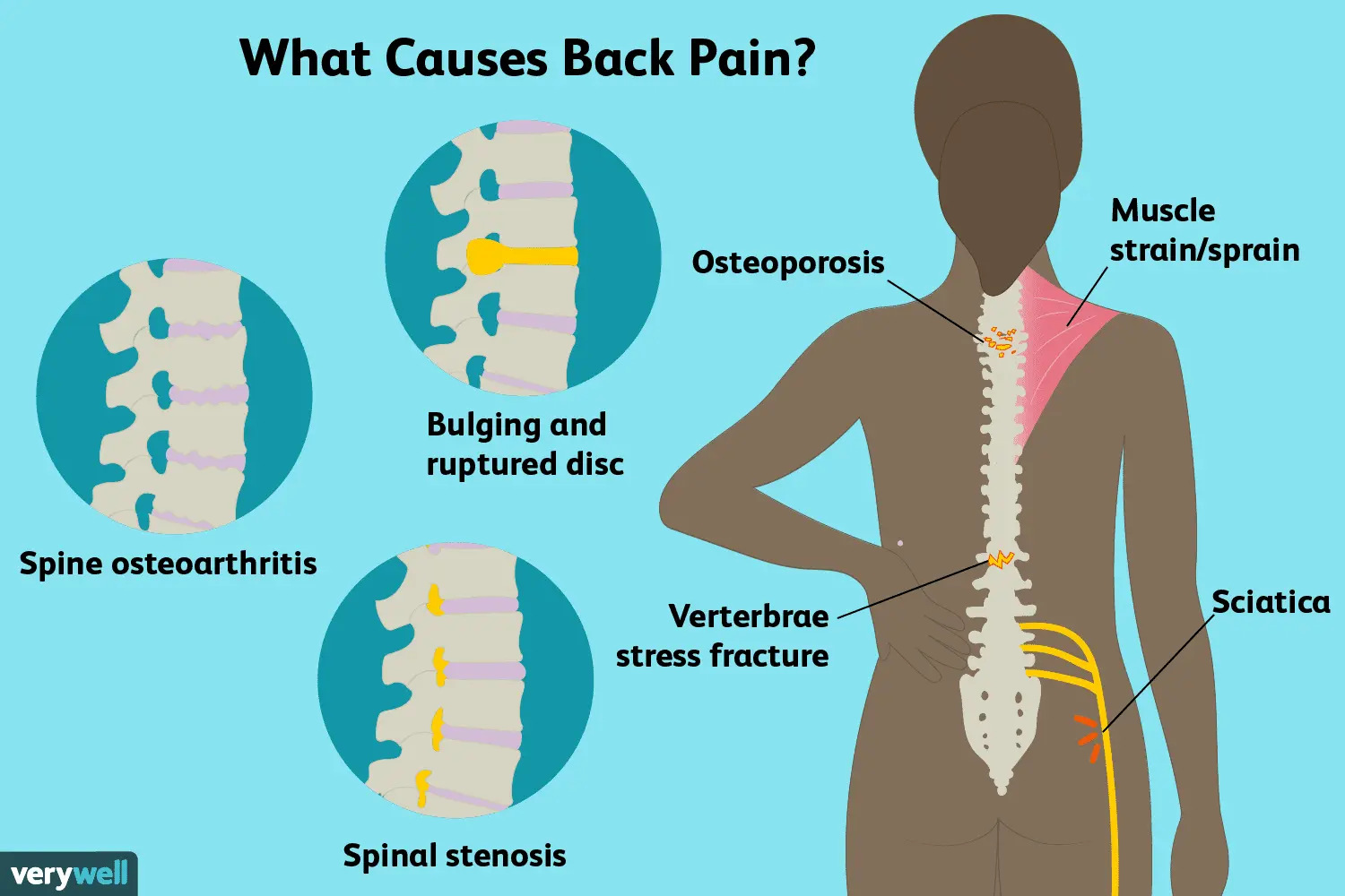 Pain in the lumbosacral region &#8211; causes, symptoms, treatment, prevention