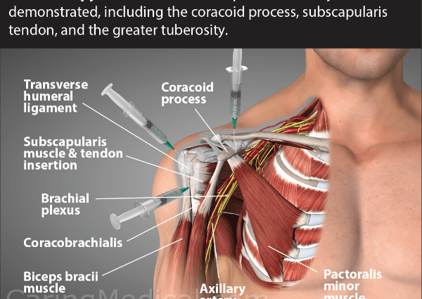 Pain in the shoulder joints. Is pharmacotherapy effective?