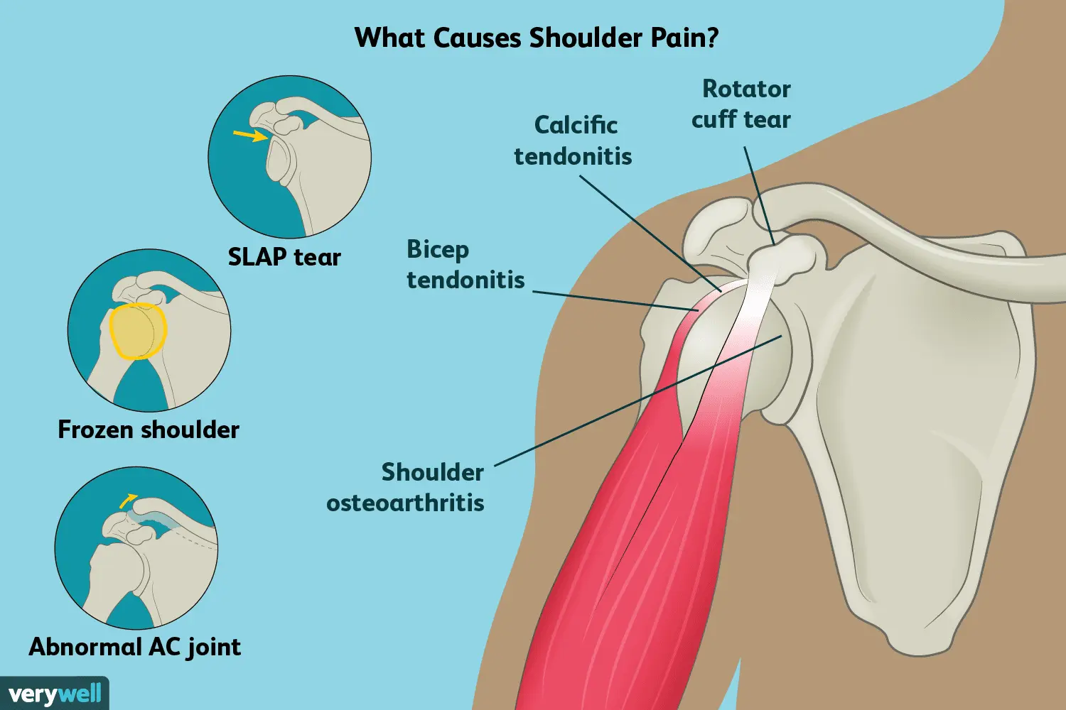 Pain in the shoulder when lifting the hand &#8211; causes, pain in the shoulder and neck