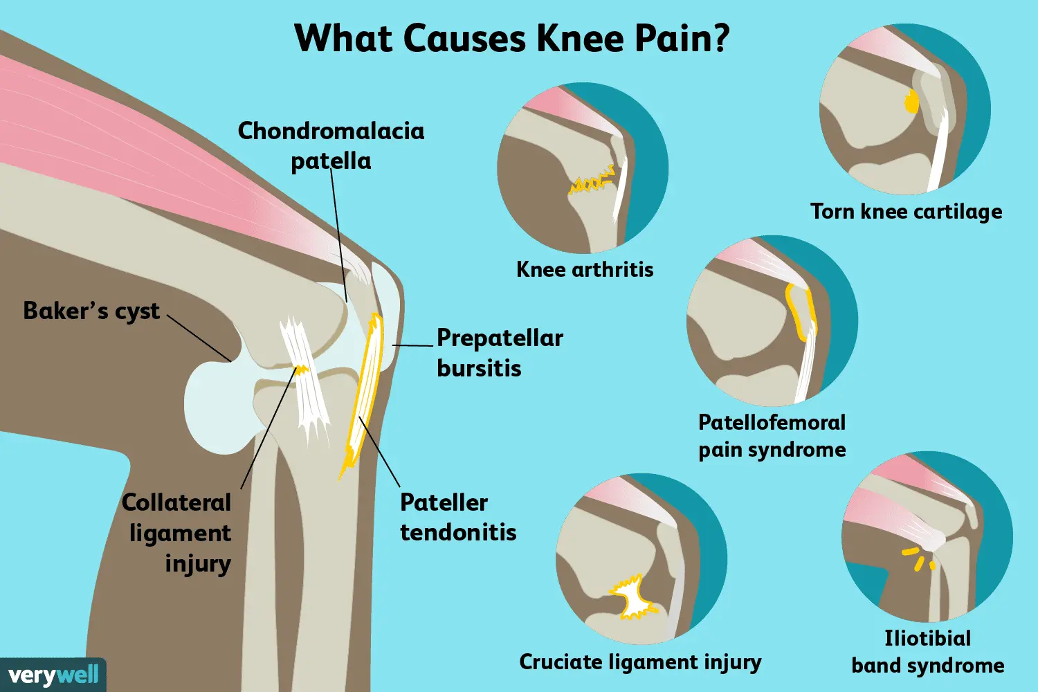 Pain under the knee &#8211; when walking, in front of how to heal