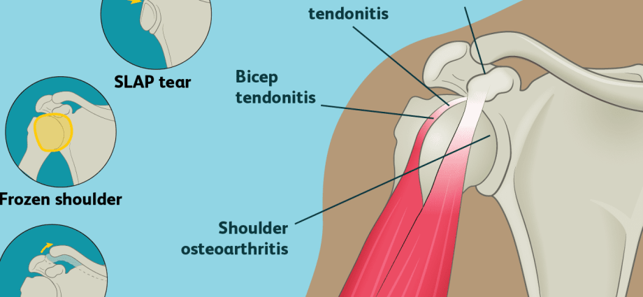 Painful shoulder syndrome &#8211; who is most often affected, treatment