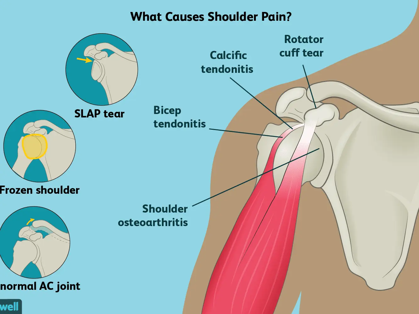 Painful shoulder syndrome &#8211; who is most often affected, treatment