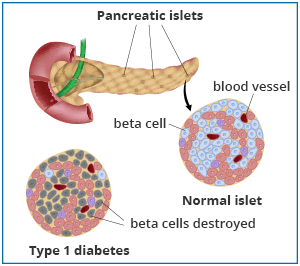 Pancreatic islet diseases &#8211; causes, symptoms, treatment