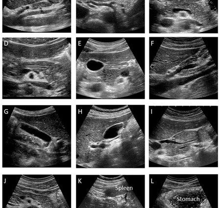 Pancreatic ultrasound &#8211; what can it detect and how to prepare for the examination?