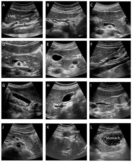 Pancreatic ultrasound &#8211; what can it detect and how to prepare for the examination?