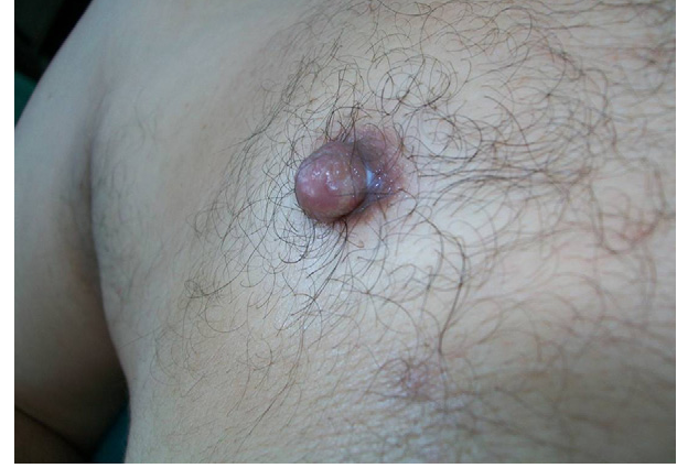 Papillary adenoma of the nipple