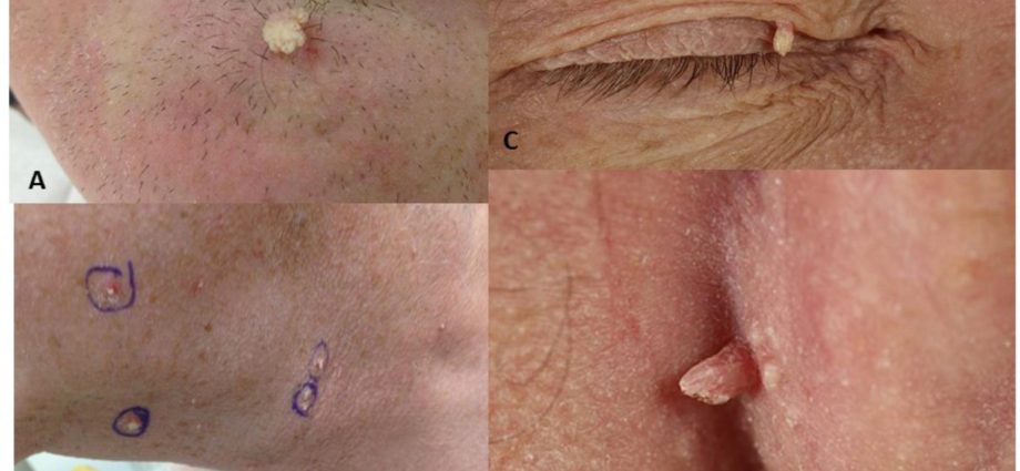 Papillomavirus associated with skin cancer