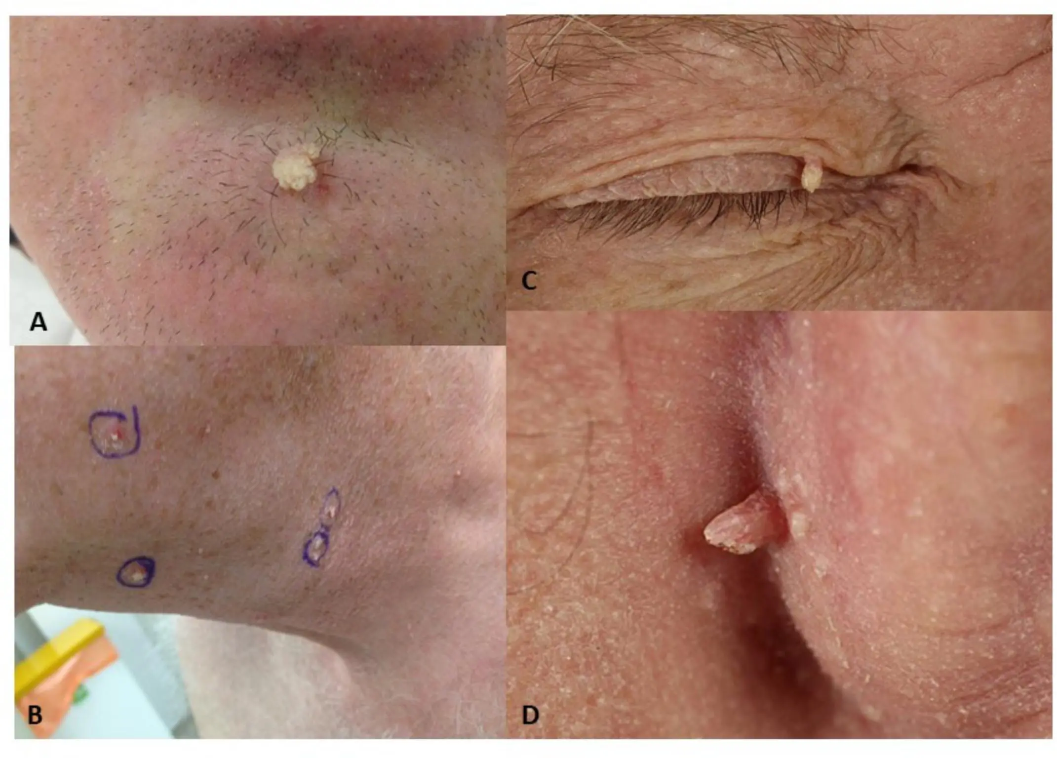 Papillomavirus associated with skin cancer