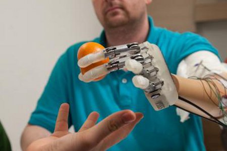 Paralyzed hands were amputated to implant bionic limbs