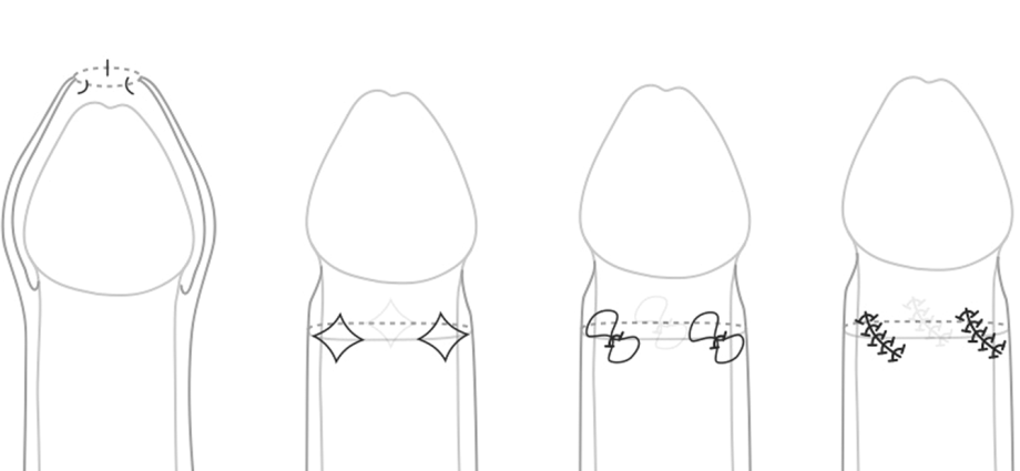 Paraphimosis, i.e. a complication of phimosis