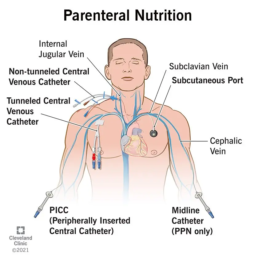 Parenteral nutrition &#8211; catheter, parenteral nutrition at home, intestinal diseases