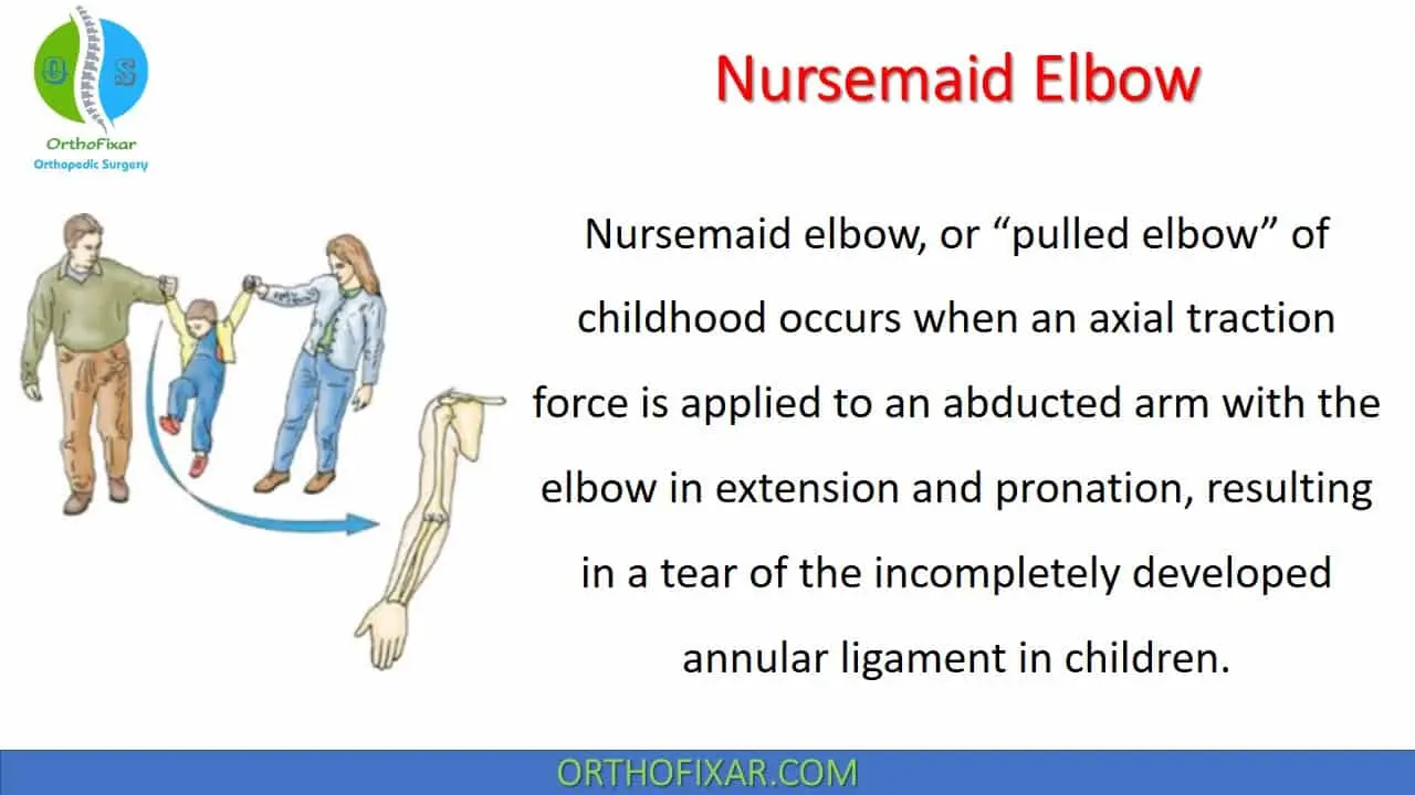 Parents are usually responsible for this common trauma in children. What is a nurse&#8217;s elbow?