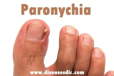 Paronychia &#8211; causes, symptoms, treatment, complications. Prophylaxis of foot rot