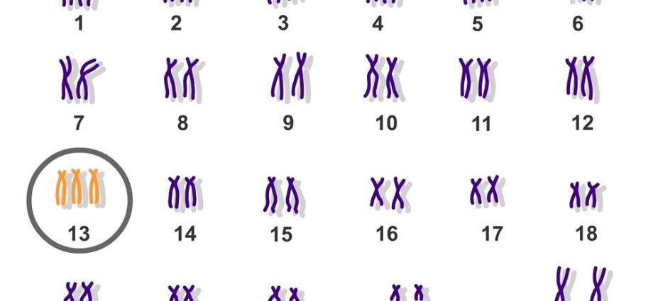 Patau syndrome (Patau syndrome) &#8211; trisomy of chromosome 13