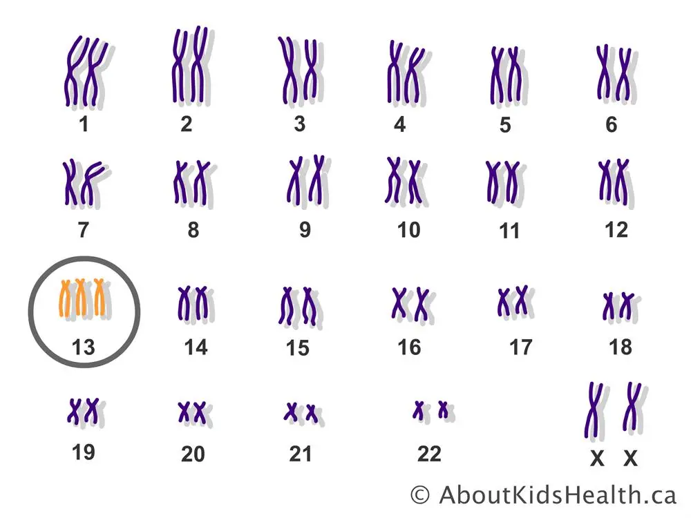 Patau syndrome (Patau syndrome) &#8211; trisomy of chromosome 13