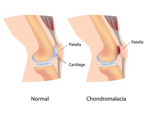 Patellar chondromalacia &#8211; what is it, causes, symptoms, diagnosis, treatment