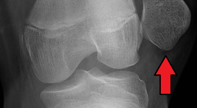 Patellar dislocation