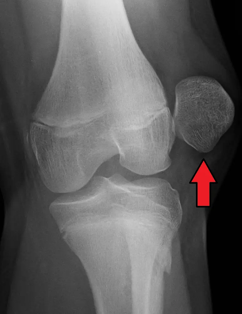 Patellar dislocation