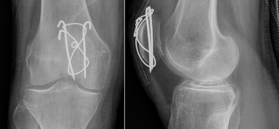 Patellar fractures &#8211; treatment