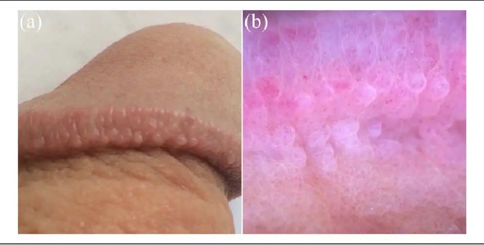 Pearly penile papules &#8211; diagnosis and treatment