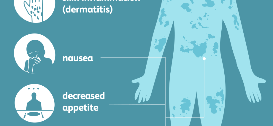 Pellagra &#8211; about the causes, symptoms and treatment of the disease