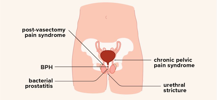 Pelvic pain syndrome