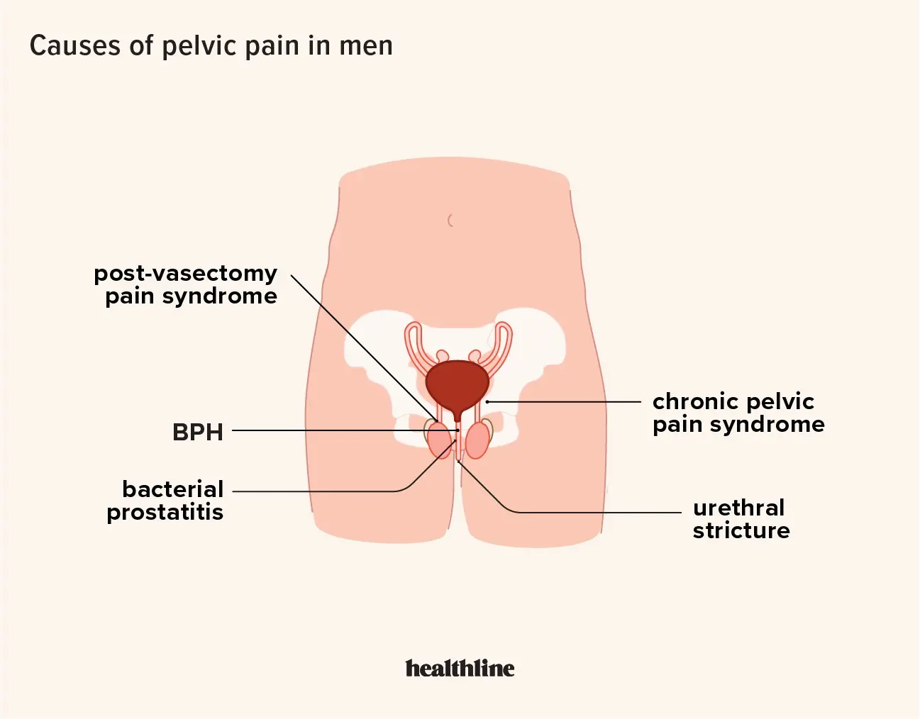 Pelvic pain syndrome