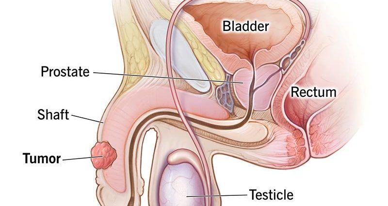 Penile cancer