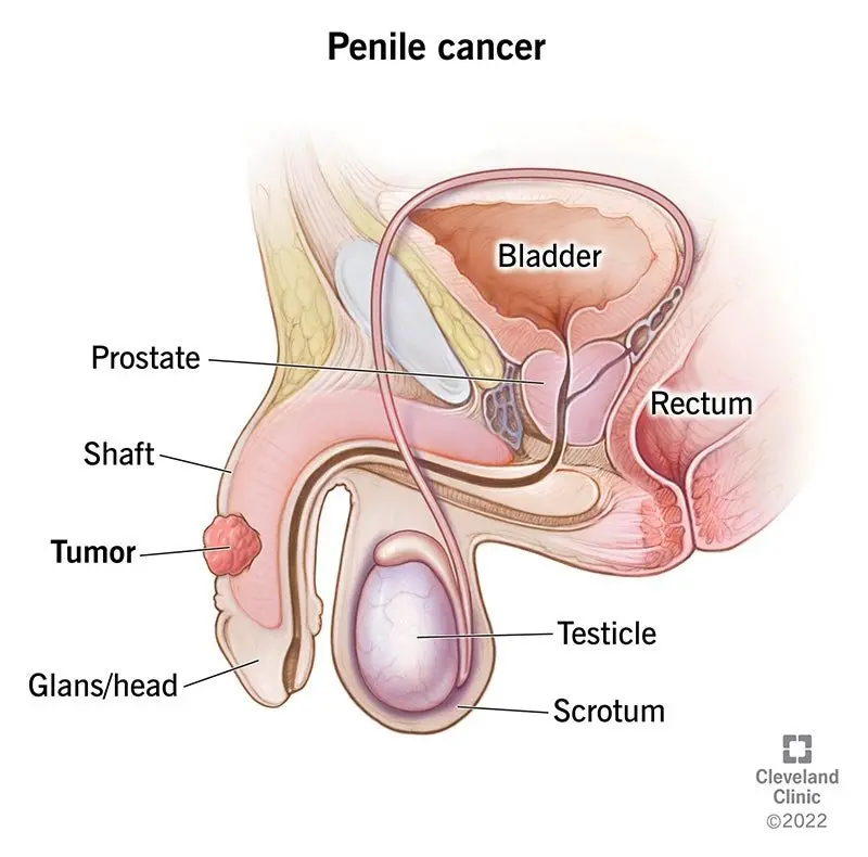 Penile cancer &#8211; causes, symptoms, treatment. Where does it come from and how to fight it?