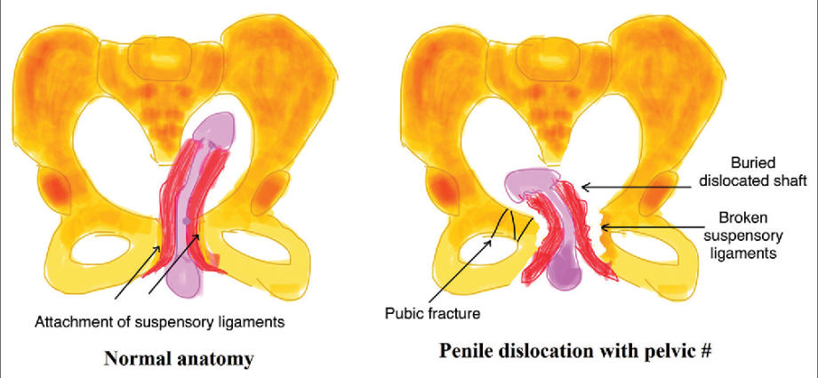 Penile dislocation &#8211; damage caused by trauma