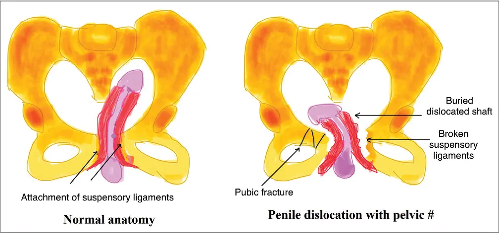 Penile dislocation &#8211; damage caused by trauma