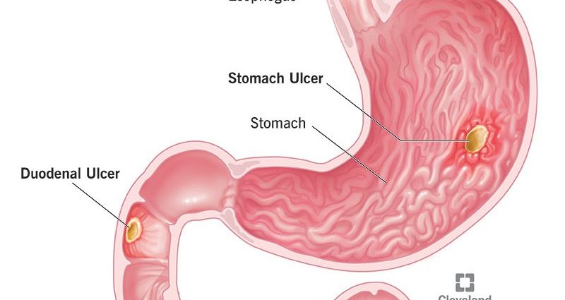 Peptic ulcer of the stomach and duodenum &#8211; causes, symptoms, treatment, complications