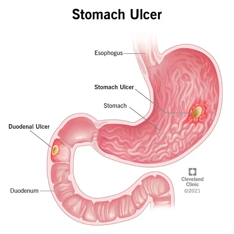 Peptic ulcer of the stomach and duodenum &#8211; causes, symptoms, treatment, complications