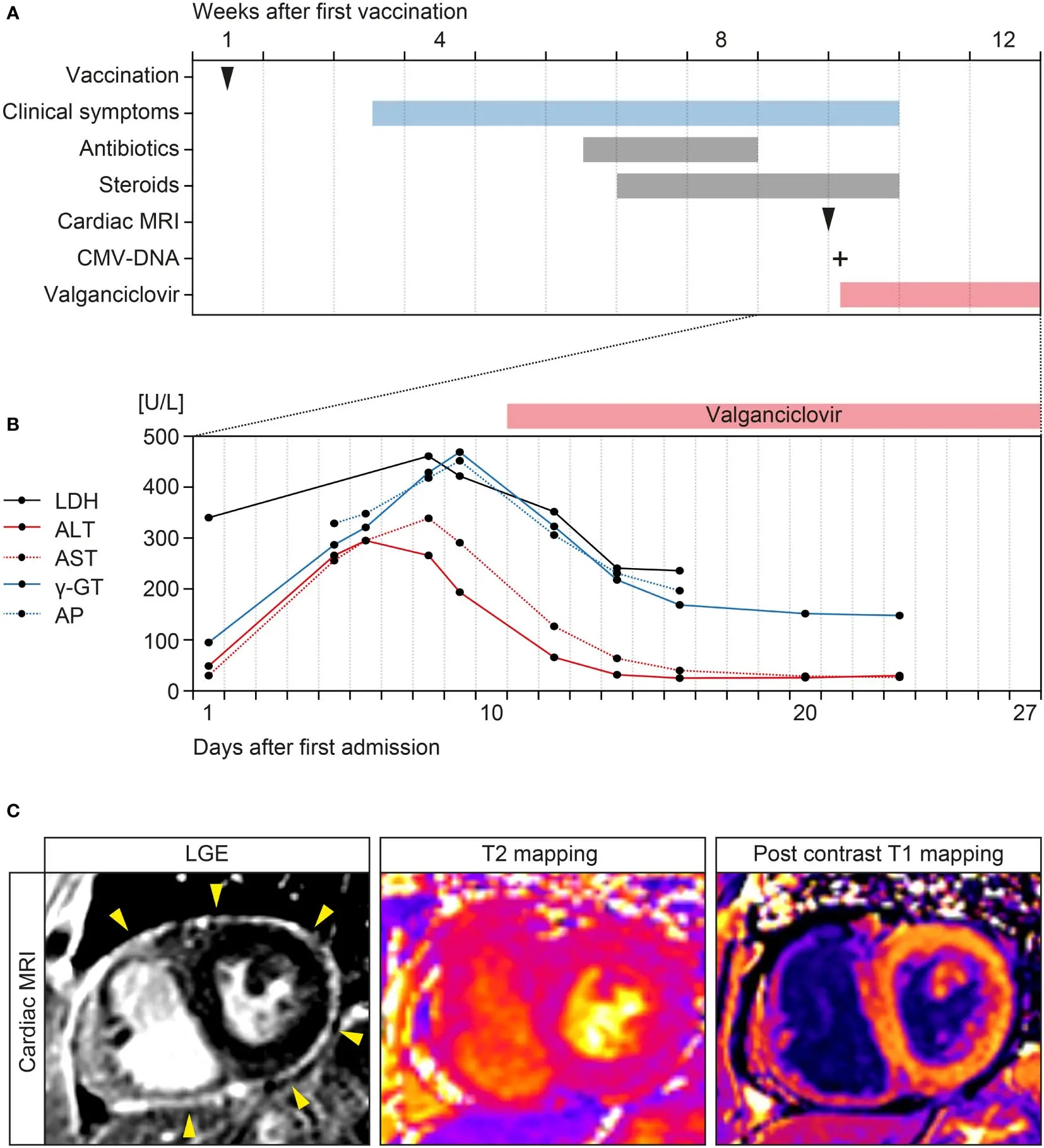 Pericarditis and myocarditis following vaccines. How many cases in Poland? [WE CHECK]