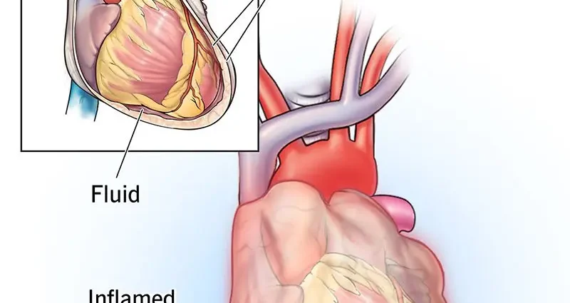 Pericarditis &#8211; types, causes, symptoms, diagnosis. What is the treatment of pericardial inflammation?