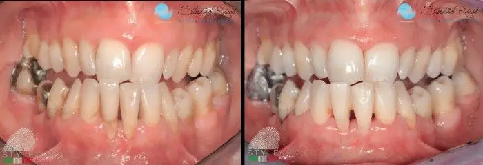 Periodontal disease &#8211; insidious tooth destroyer