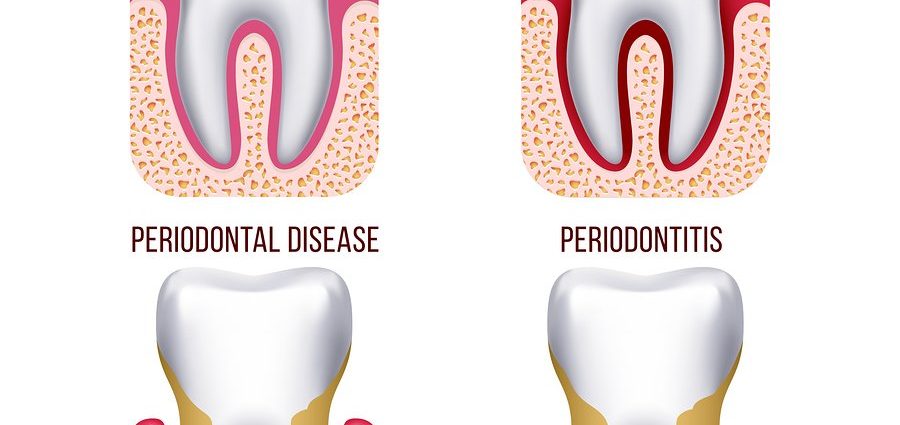 Periodontal diseases &#8211; types, causes, treatment and prevention