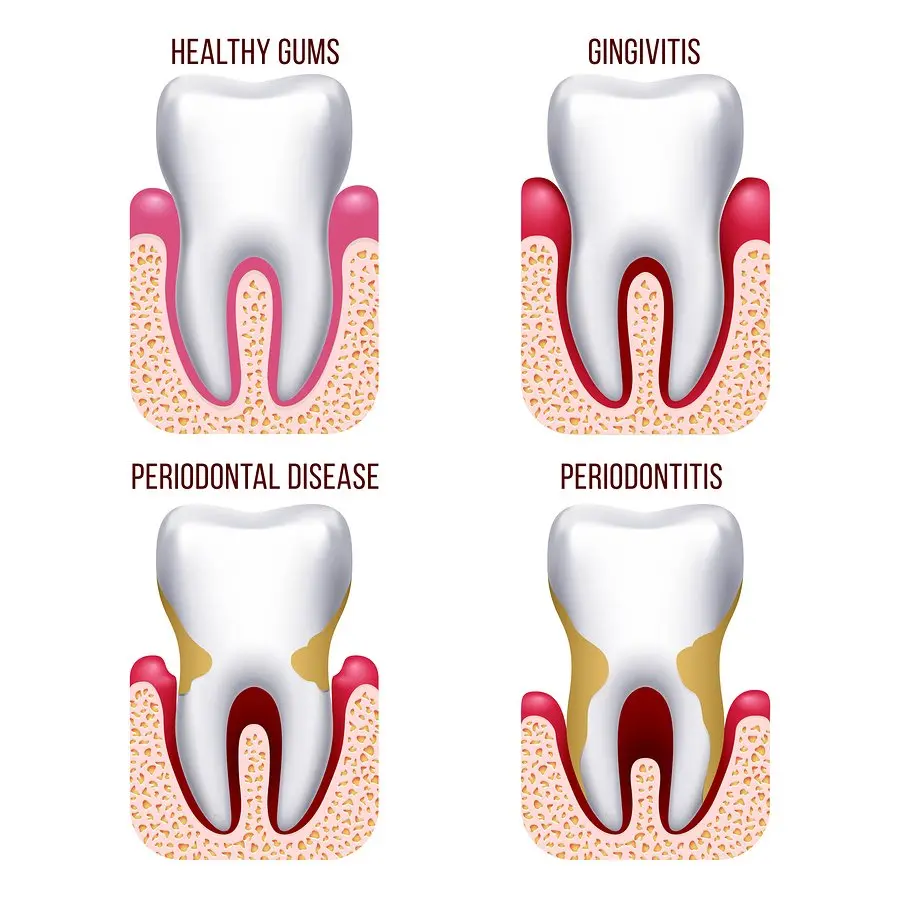 Periodontal diseases &#8211; types, causes, treatment and prevention