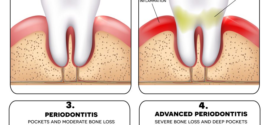 Periodontitis &#8211; a disease that affects every second of us. How to recognize and treat it?