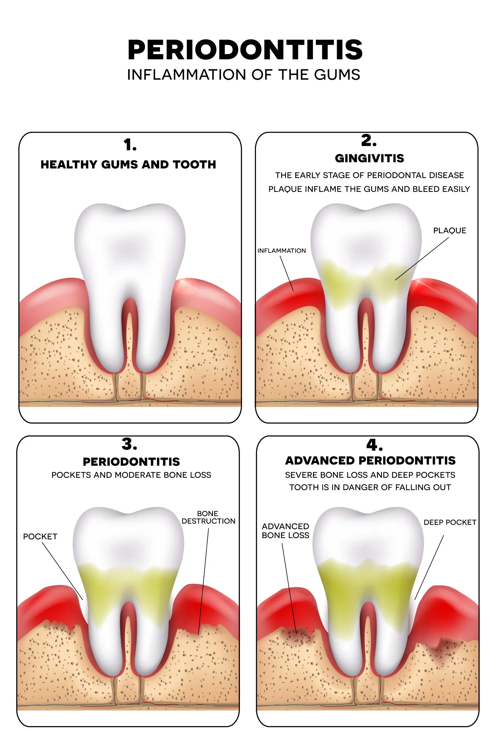 Periodontitis &#8211; a disease that affects every second of us. How to recognize and treat it?