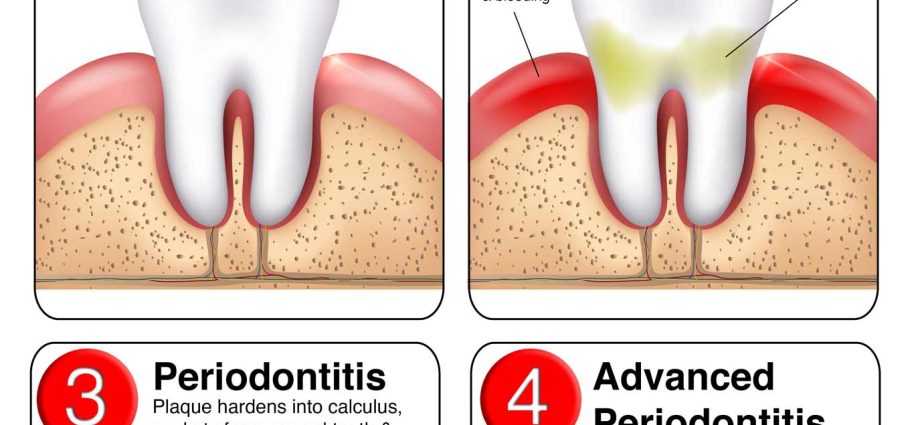 Periodontitis Causes Symptoms Treatment We Explain Healthy Food